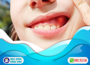 nguyên nhân gây viêm nướu răng ở trẻ