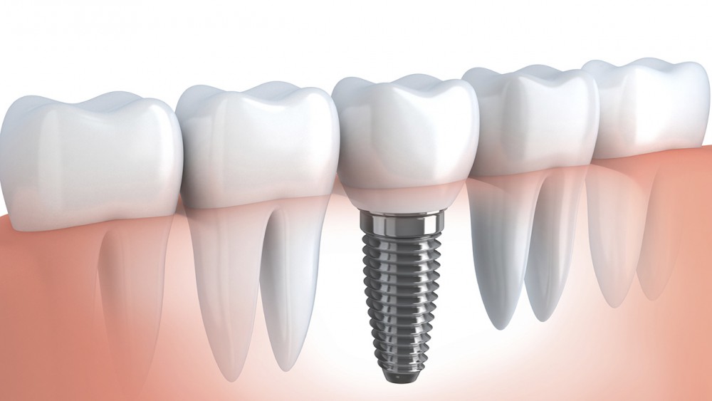 Tại sao nên cắm ghép implant cho răng