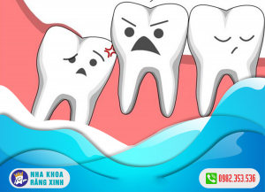 Răng khôn và răng cấm khác nhau như thế nào ?