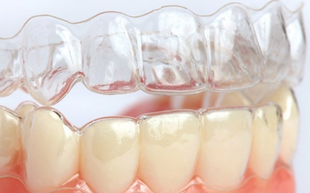 Niềng Răng Trong Suốt Tại Vinh- 3D Clear