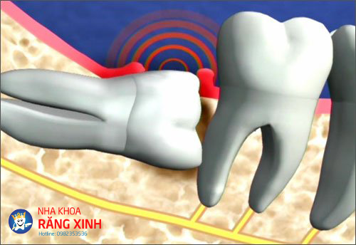 Nhổ răng khôn không đau tại địa chỉ nha khoa uy tín Răng Xinh