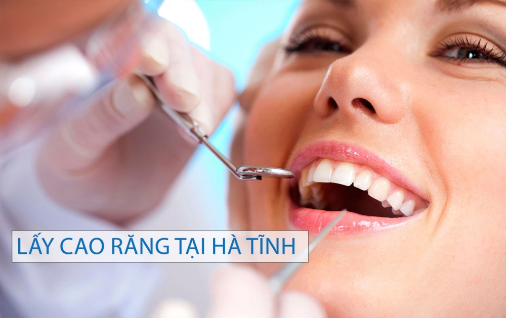Lấy cao răng tại Hà Tĩnh