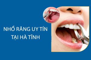 Nhổ răng tại Hà Tĩnh uy tín