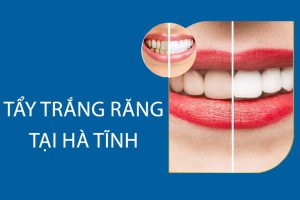 Tẩy trắng răng tại Hà Tĩnh